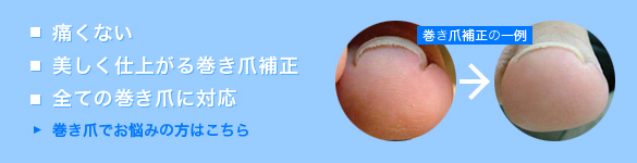 巻き爪でお悩みの方はこちら